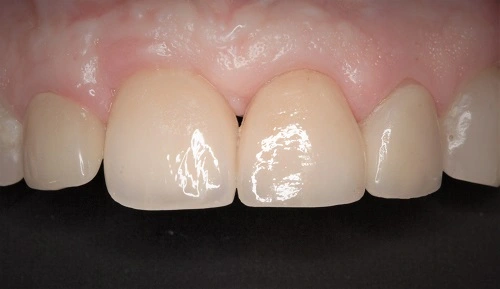 Close-up of clean, healthy human teeth.