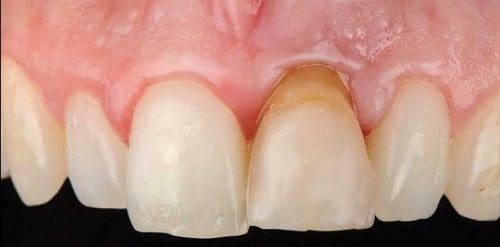 Discolored tooth with gum recession, close-up.