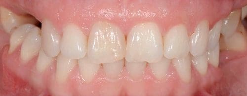 Close-up of human teeth and gums.