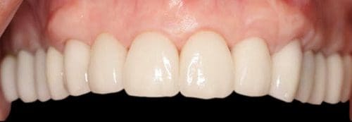 Close-up of a set of human teeth.