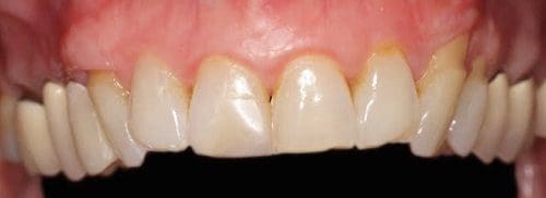 Close-up of upper front teeth and gums.