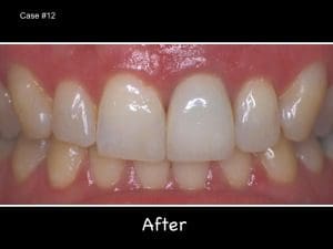 Teeth after dental treatment, close-up view.