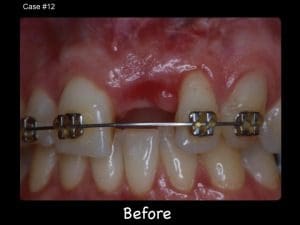 Teeth with braces before dental procedure.